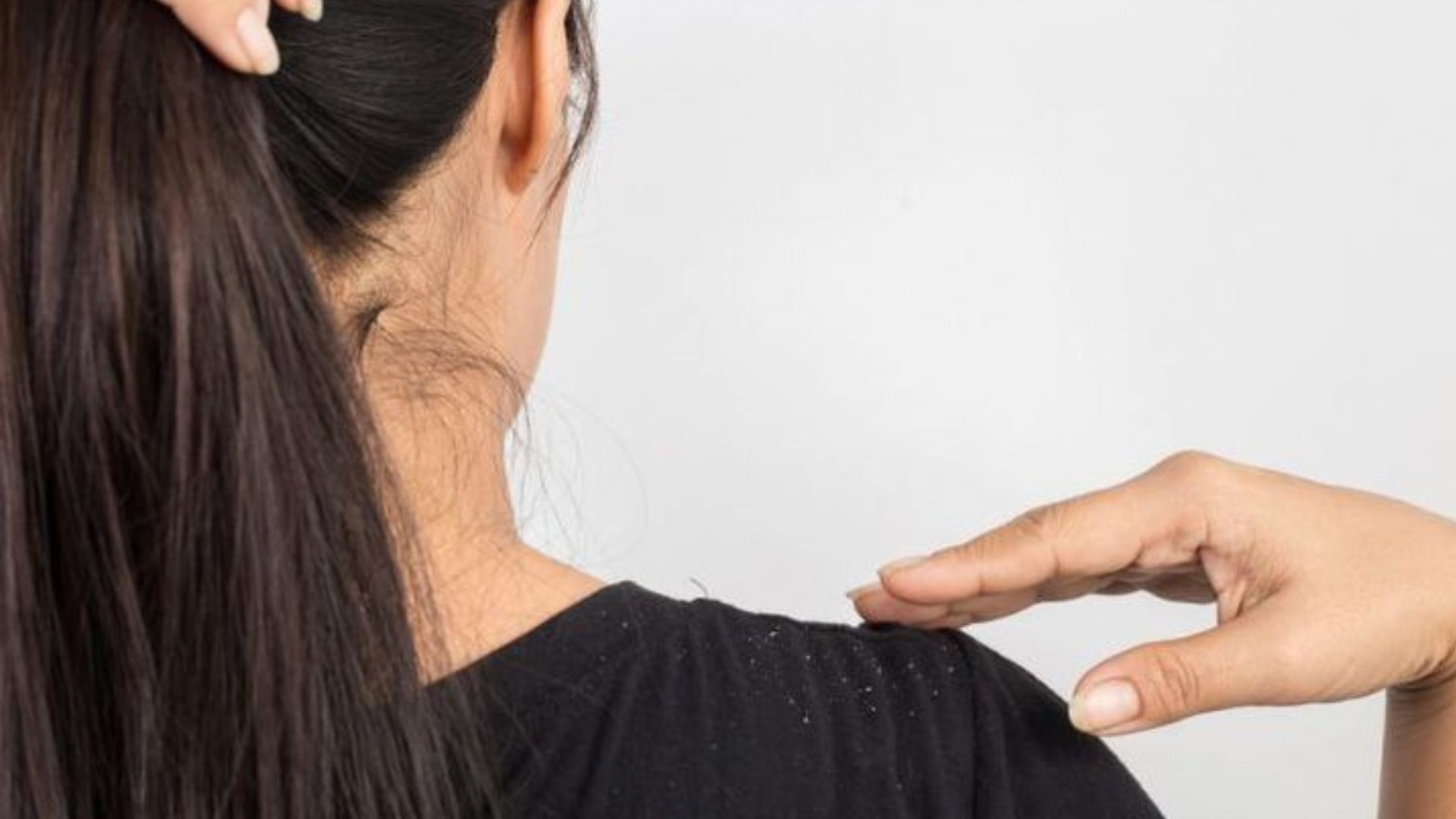 Dandruff Treatment1