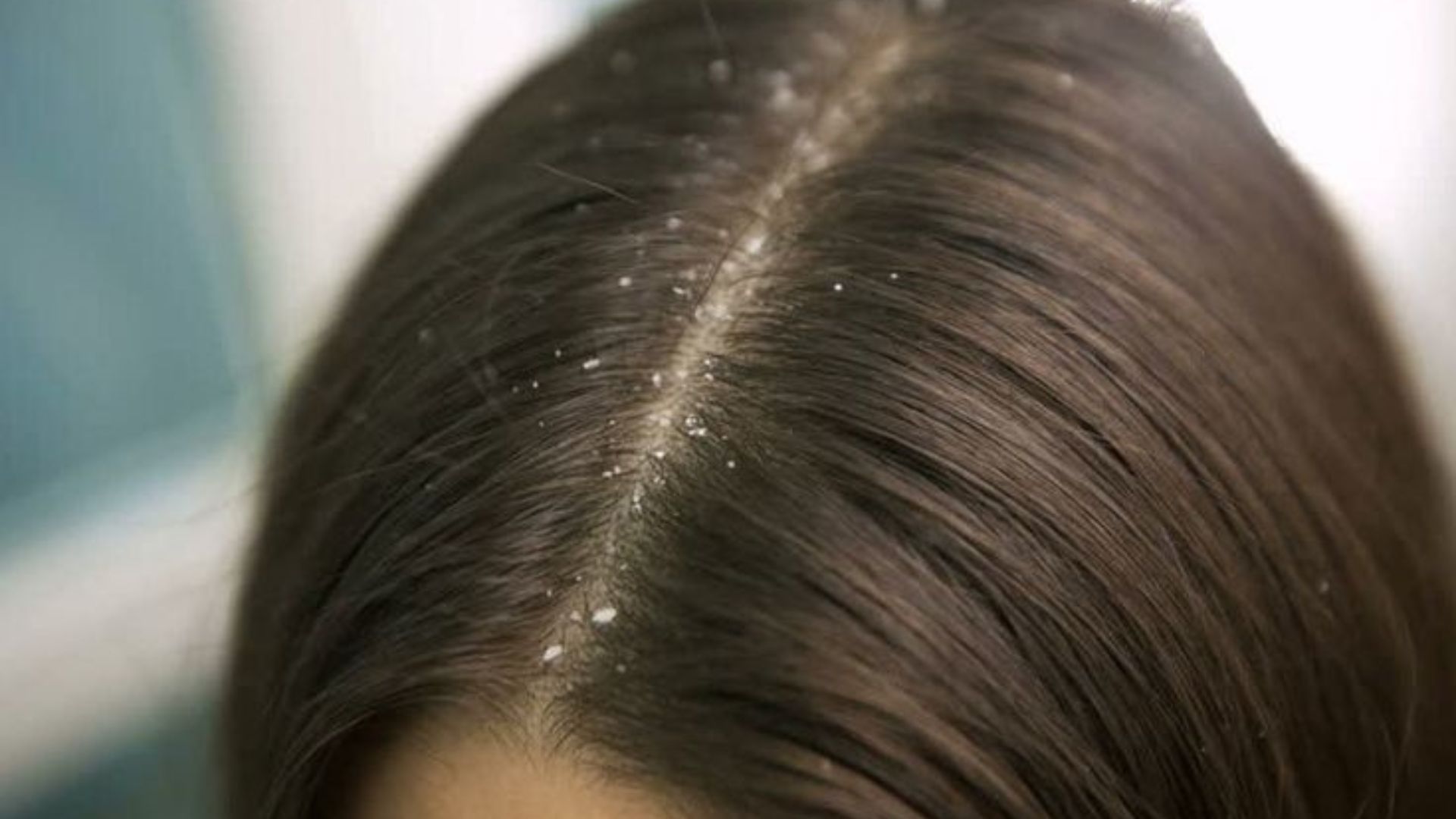 Dandruff Treatment2